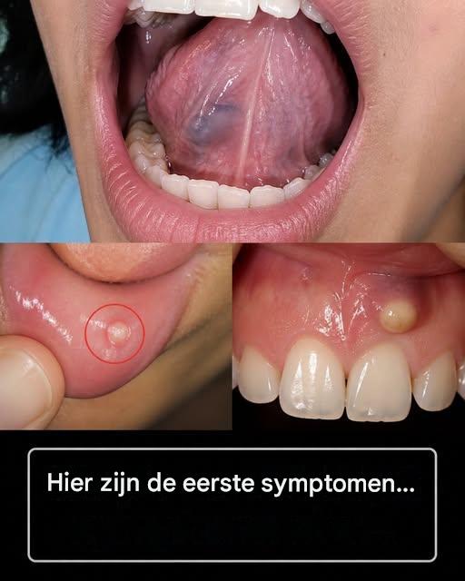 Verborgen gevaren voor de mond: 8 vroege symptomen van mondkanker die u nooit mag negeren
