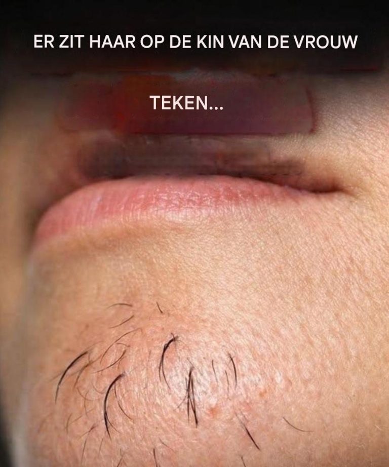 Kinhaar bij een vrouw is een teken van… Lees meer