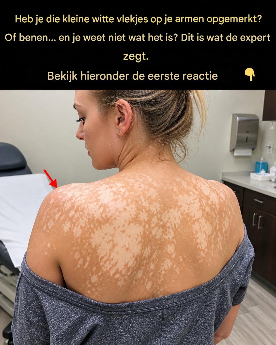 Waarom verschijnen er witte vlekken op de huid? Verborgen oorzaken die niet negeren mogen worden.