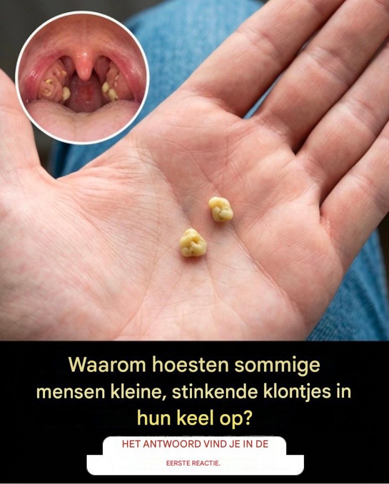 Galstenen: Wat is het en hoe kom je er vanaf?