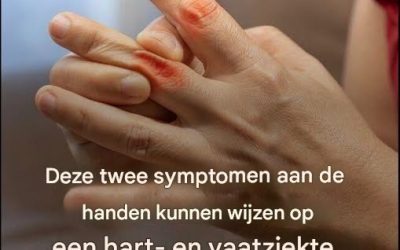 Deze twee symptomen aan de handen kunnen wijzen op een hart- en vaatziekte.