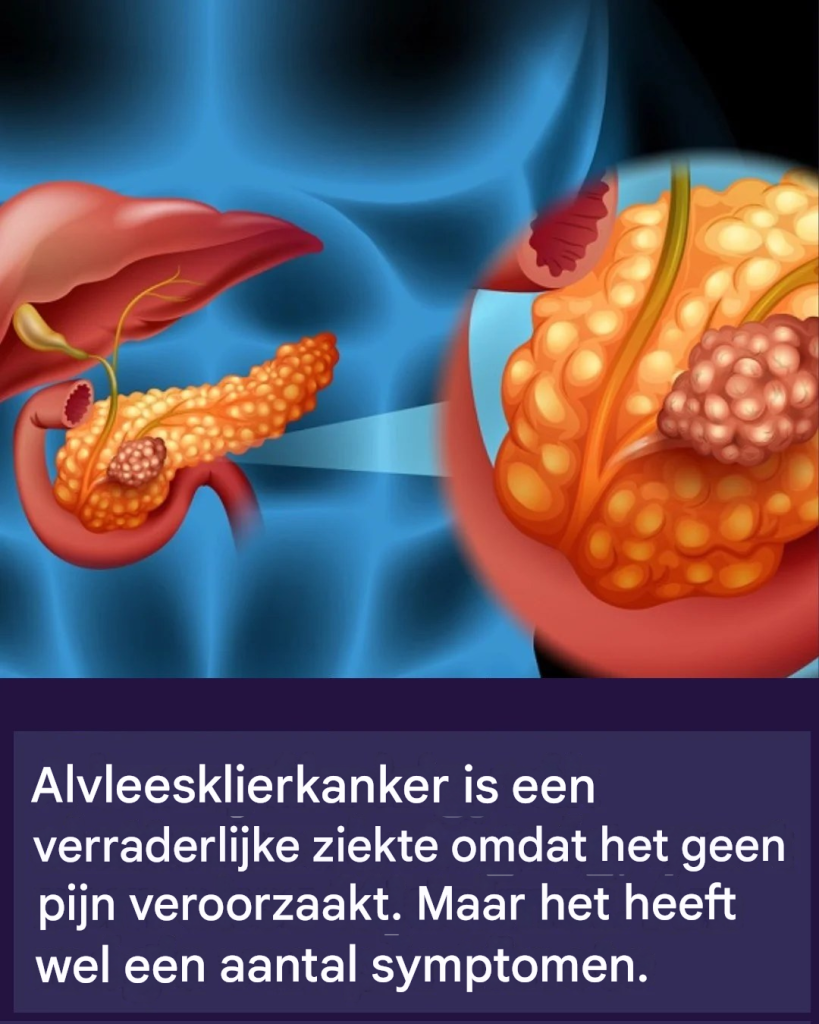 Alvleesklierkanker is een verraderlijke ziekte omdat het geen pijn veroorzaakt. Maar het heeft wel een aantal sympathisanten.