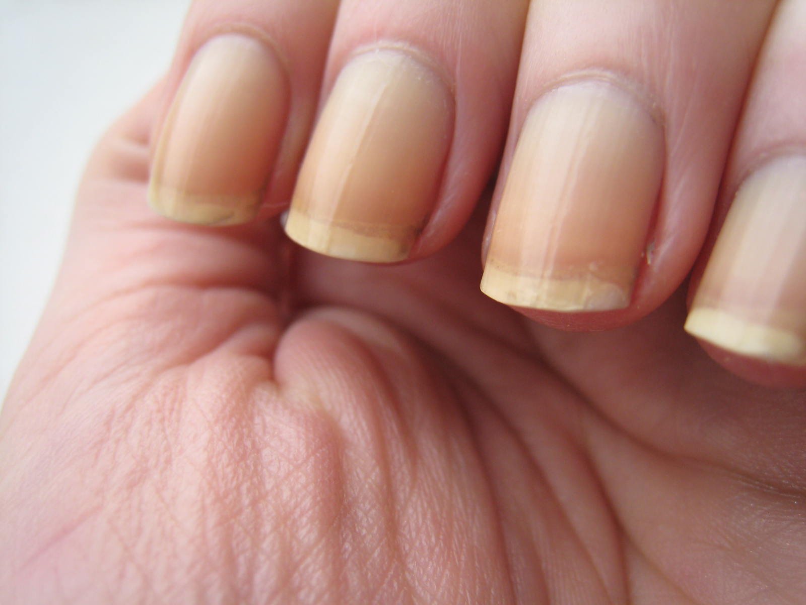 Zijn je nagels regelmatig broos, gebarsten of splijten ze? Dat is geen kleinigheid: je lichaam geeft je een signaal.